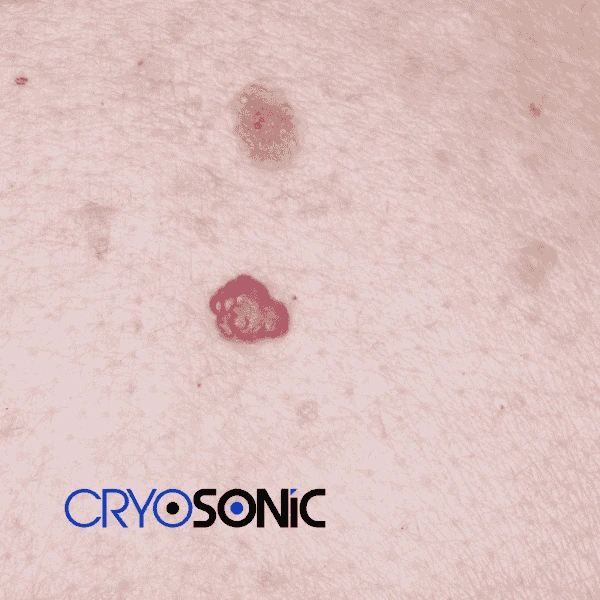 Looking for pain free cherry angioma removal treatment York? Call our team today! York