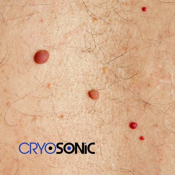 get cherry angioma removal treatment today! York