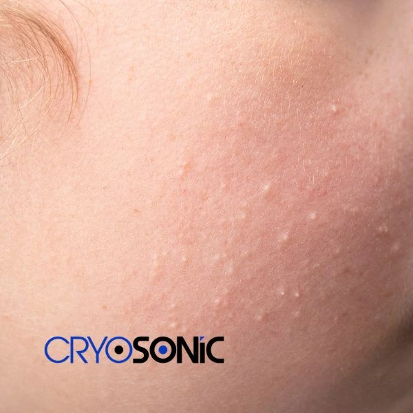 Are you looking for milia removal treatment? Contact our team today York