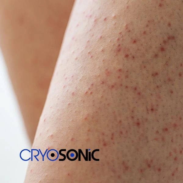 Looking for Seborrhoeic Keratosis removal York treatment? Call our consultants today in York