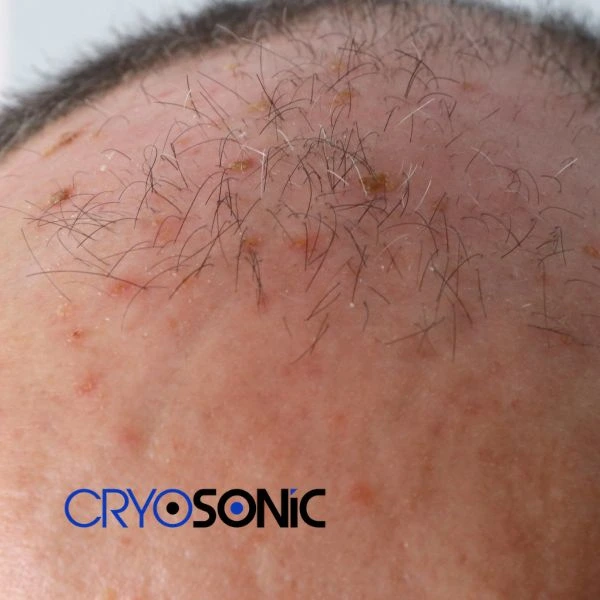 Access Seborrhoeic Keratosis removal from the comfort of your own home! Call us today in York