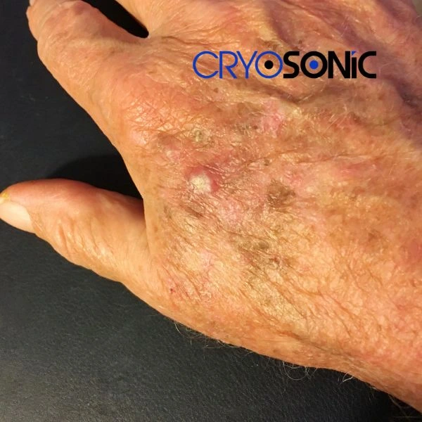 Understand more about actinic keratosis treatment today York