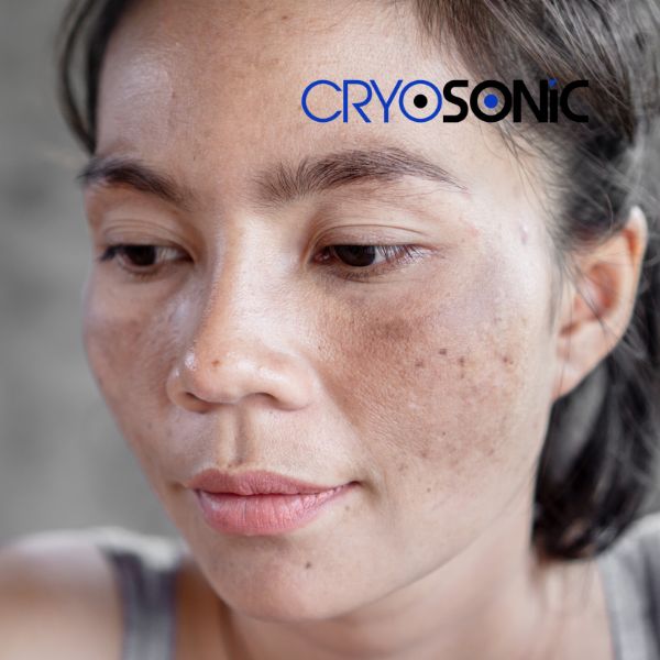 Ready to start age spots removal? Contact our team today in York