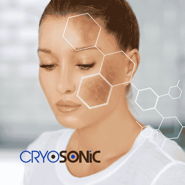 Are you looking for age spot removal treatment? Contact Cryosonic today in York