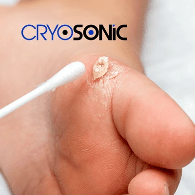 Cryosonic blemish removal for children York