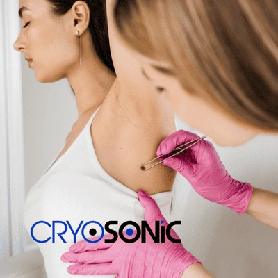 With cryosonic you can book for treatment even in your own home! York