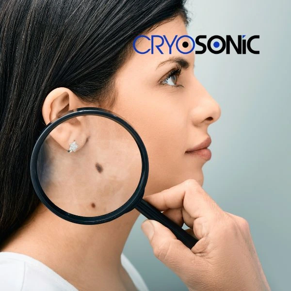 Do you want to learn more about benign moles removal treatment? Call our team today York