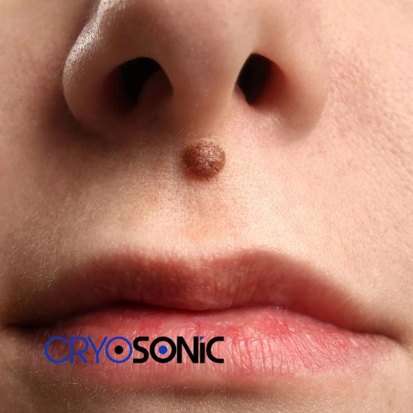 Start your benign moles removal treatment today York