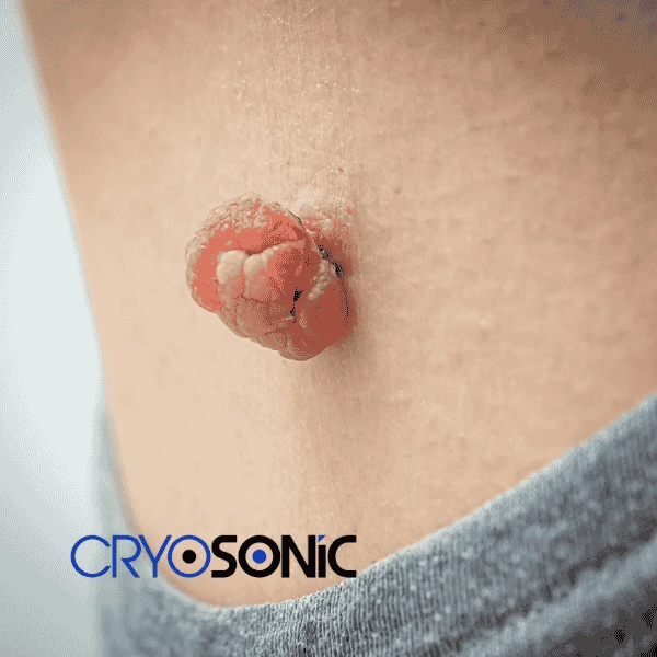 Book your skin tags removal York from comfort of your own home! York