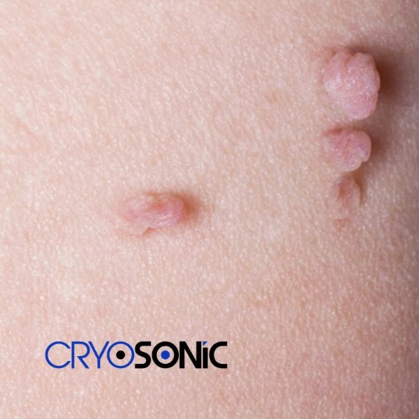 Are you looking for fast effect skin tag removal York? Book in NOW! York