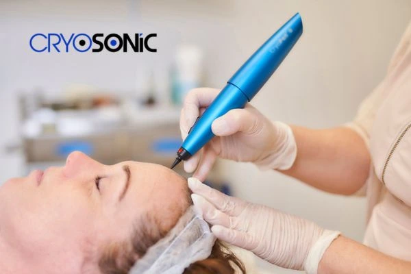 Cryopen Aftercare Tips York