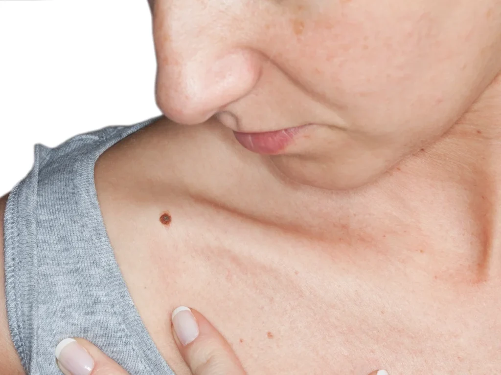 How Does CryoPen Sun Damage Treatment York Work? York