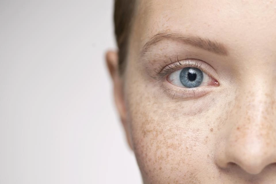 Understanding Sun Damage: How UV Rays Alter Skin and How CryoPen Can Reverse It York