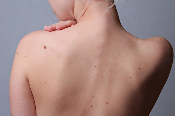 The Skin’s Healing Journey After CryoPen Sun Damage Treatment York