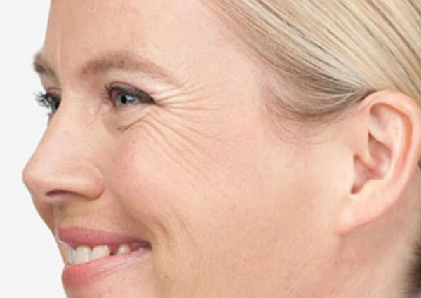CryoPen Precision vs. Laser: Which Is Better for Sun-Damaged Skin? York