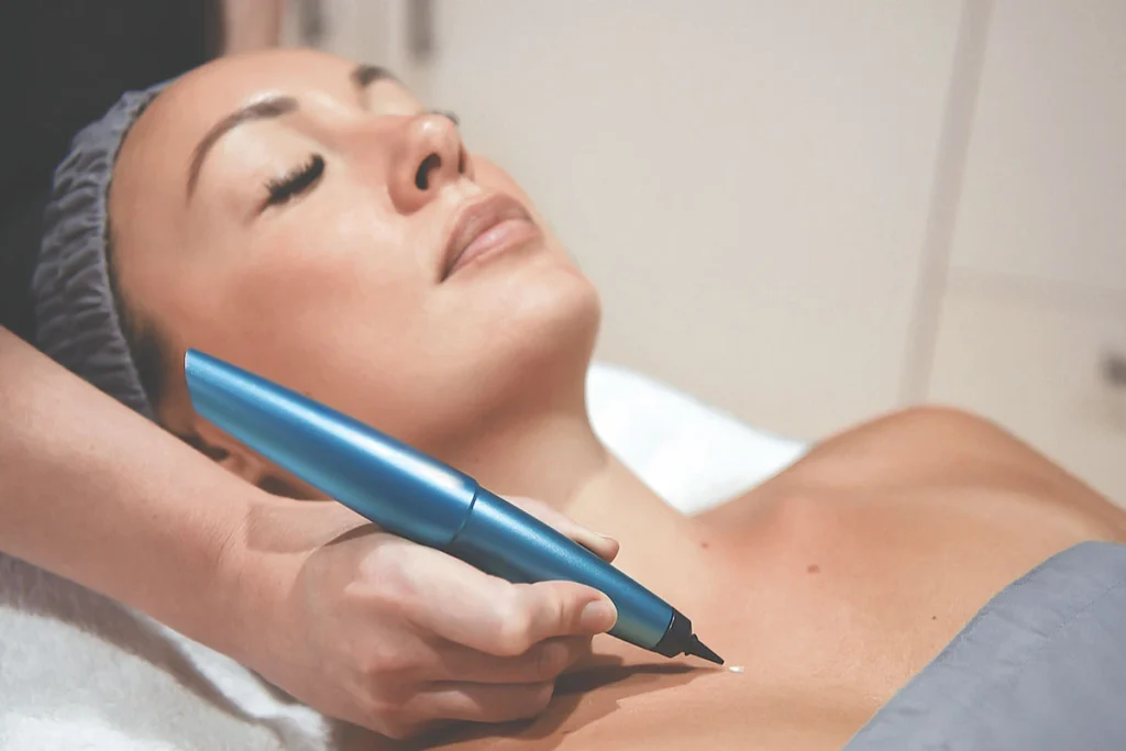 What is CryoPen Technology York? York