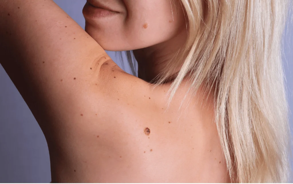 What Are Sun Spots and Pigmentation York? York
