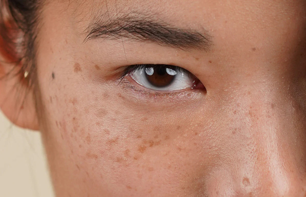 Is There Any Risk of Scarring or Pigmentation York? York