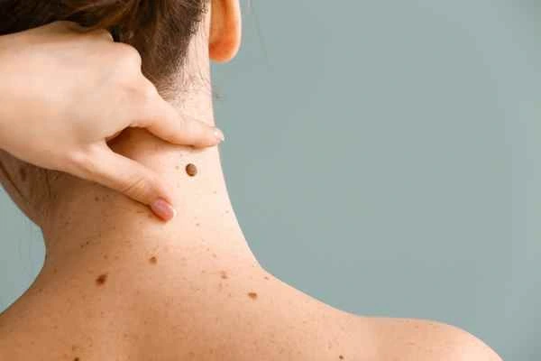 Who Should Avoid CryoPen Treatments? York