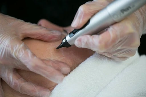 The CryoPen Technology Explained: How Extreme Cold Removes Sun-Damaged Skin Cells York