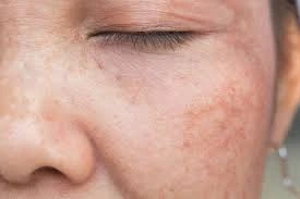 CryoPen Precision vs. Laser: Are Both Treatments Safe? York