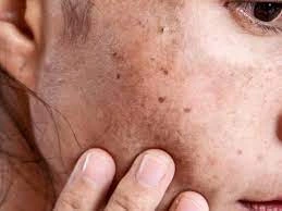 Why CryoPen Works Best for Isolated Sun Spots and Pigmentation York