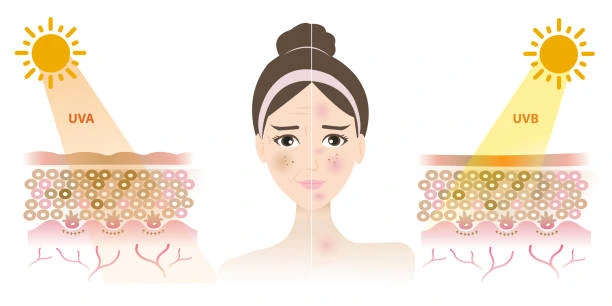 Understanding Sun Damage York : How Do UV Rays Cause Changes in the Skin? York