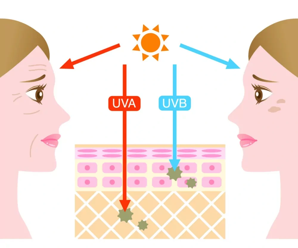 Understanding Sun Damage York - Why Should Sun Damage Be Treated Early? York
